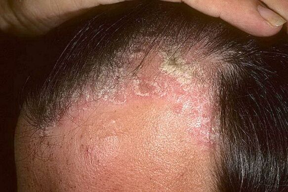 Symptome der Psoriasis