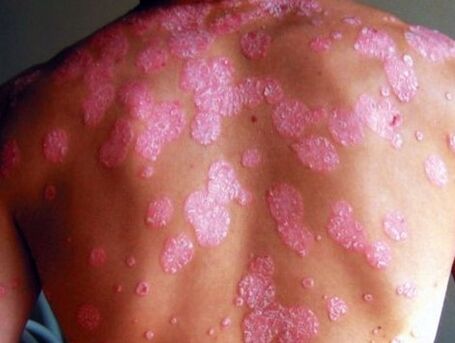 Psoriatische Krankheit