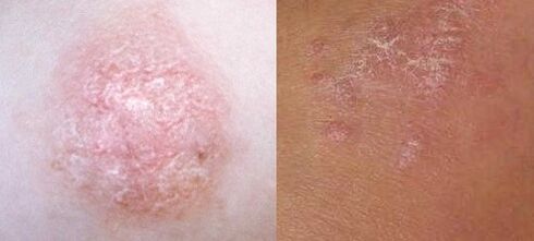 Psoriasis in der Anfangsphase